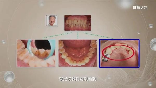 牙菌斑|牙龈出血要重视！尽早就医是关键！不然一口牙就保不住了