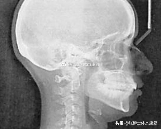 「译文分享」颞下颌关节与腘绳肌之间的联系，骨盆如何影响面部