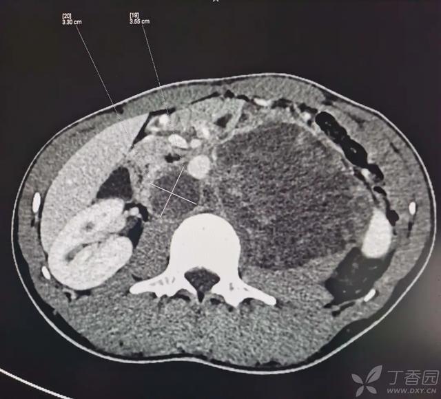 小伙子腹胀腰痛一个月，竟然是这个病