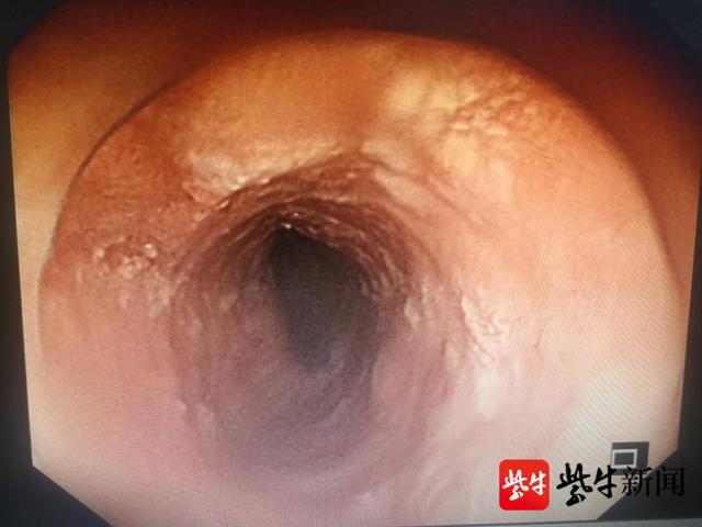 病变|食管粘膜“瘤变”了！“医林绝技”成功挽救，耄耋老人迎新生