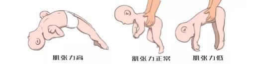超级宝妈■“肌张力高”是个什么鬼？你被儿保医生吓到过吗？