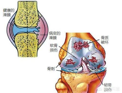 膝关节炎|膝关节炎的手术治疗（一）：软骨移植、膝关节镜。