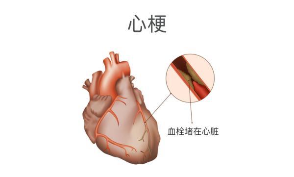 低血压|起猛了「眼前一黑」，低血压？低血糖？其实是……