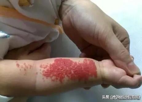 「超级宝妈」患血管瘤的宝宝一定需要处理吗？