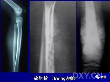 9个骨肿瘤医学影像诊断分析基本要点，如此精彩怎能错过