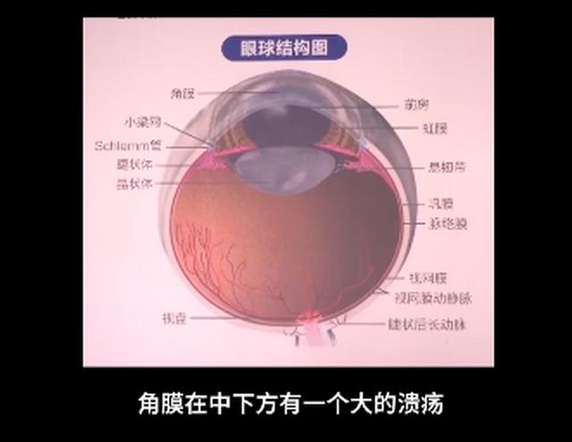 10岁男孩感染真菌眼角膜溃烂，医生：孩子经常抠脚后揉眼睛