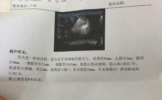 烟雨琴殇|剖腹产与顺产相比，就没有任何好处吗？这3点好处顺产比不上