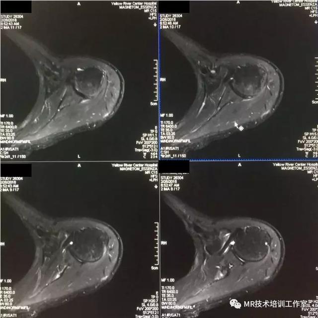 做磁共振检查最易忽视告知受检者去除的两类物品，你可能真没想到