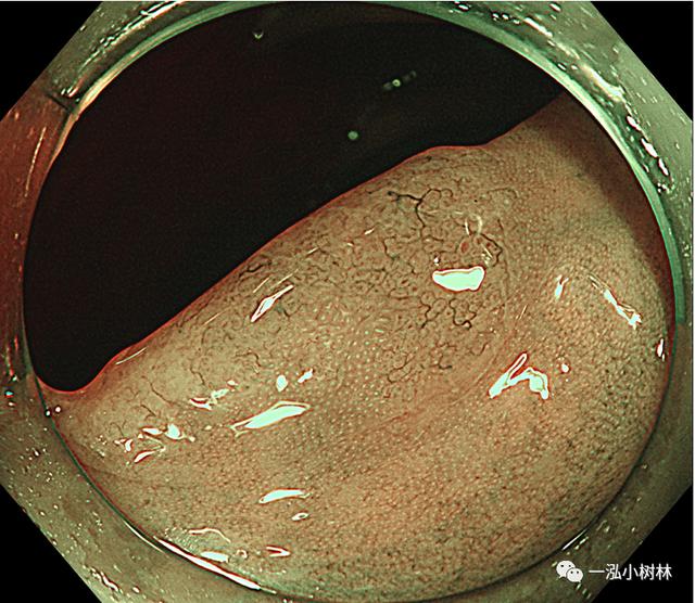 TSA与SSL内镜与病理病例分享 | 内镜集锦