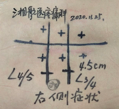 50岁李阿姨，腰间盘突出导致右腿麻木，一个“小手术”轻松解决