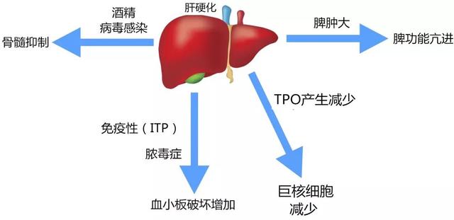 肝硬化并发血小板减少的原因和治疗手段｜一文掌握