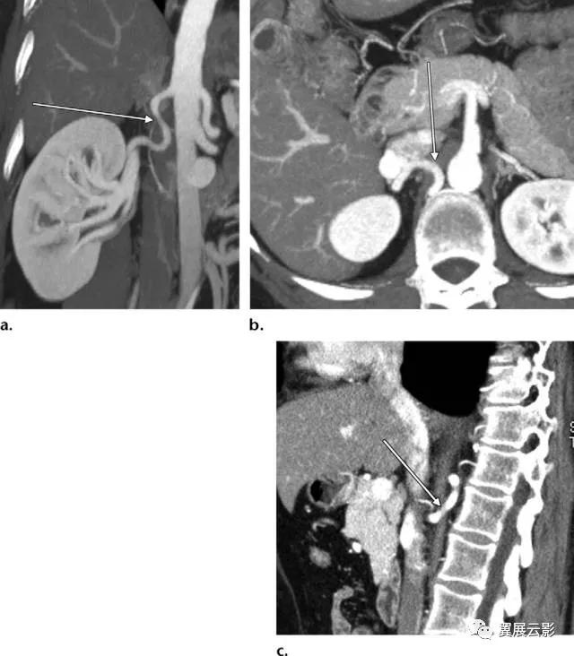 24张图汇总「肾血管」常见病变的影像学表现