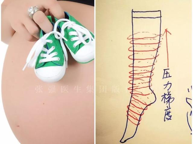 [你的育儿经]「鼠年“鼠你好孕”」做到这3点，让你轻松应对孕期下肢静脉曲张