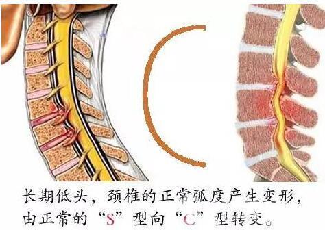 颈椎病，你不可错过的几个治疗小妙招