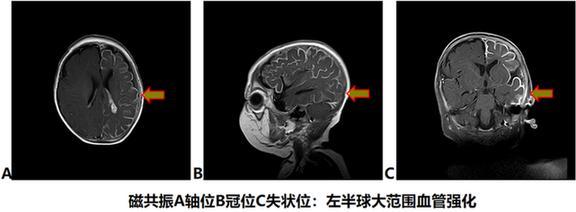 癫痫|面部红斑宝宝一天癫痫发作60余次 半球离断术为其除病魔
