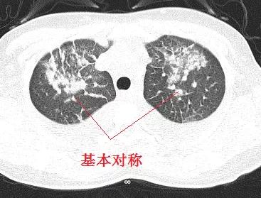 「典型」的肺水肿，为何用抗生素狂轰滥炸？