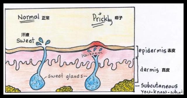 超级宝妈：干货！宝宝长痱子怎么办？“对症护理”帮助宝宝轻松过夏天