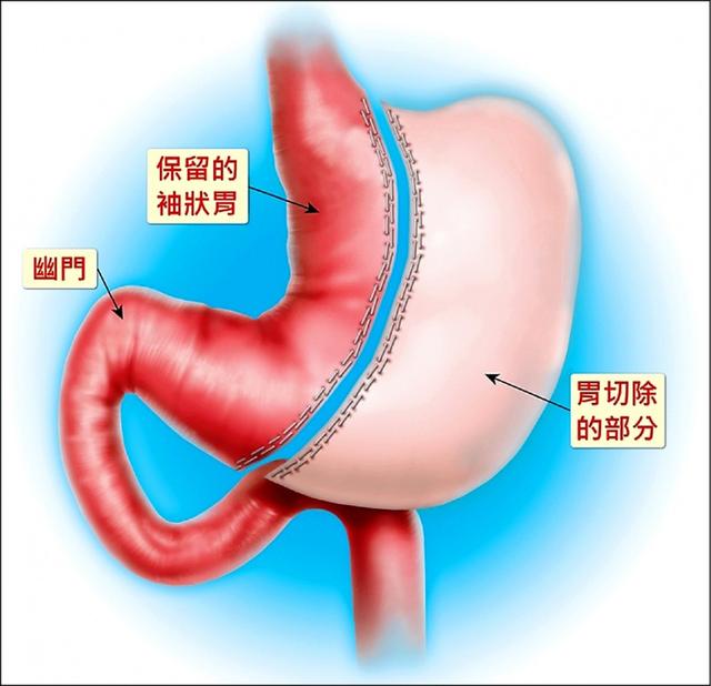“切胃”真能瘦下去？医生：可以，但减重手术非人人适合