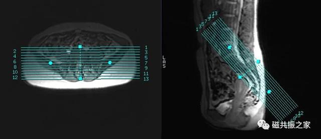 磁共振（MRI）骶尾椎扫描技术