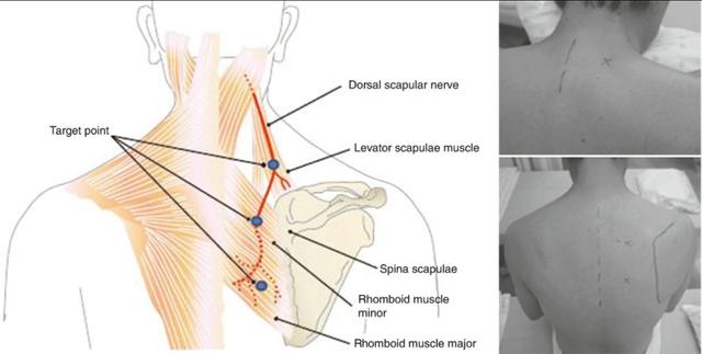 长时间低头玩手机，肩胛骨边缘隐隐作痛，要警惕DSN