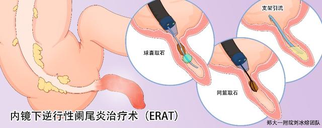 阑尾|刘冰熔团队在内镜下逆行阑尾治疗术上取得创新性突破