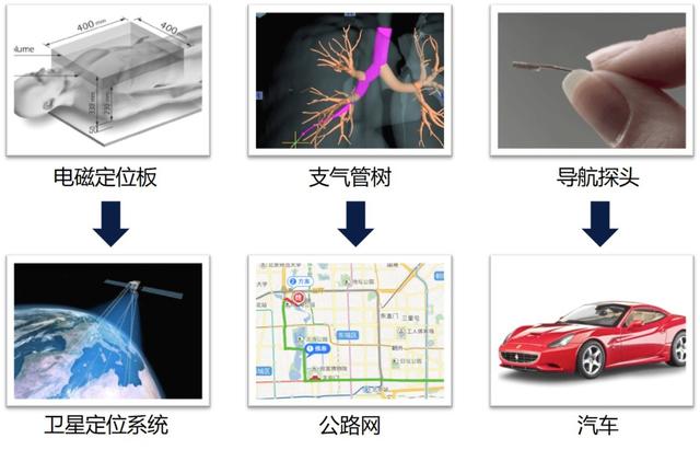 支气管镜|对付磨玻璃结节的新武器，气管里的“导航系统“来了