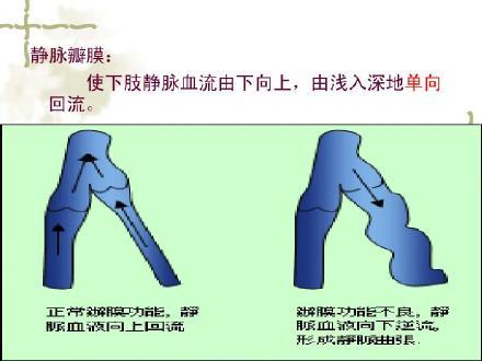 下肢|下肢静脉曲张是怎么回事