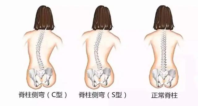 侧弯|2%的孩子都会有的脊柱侧弯，父母需要了解这些