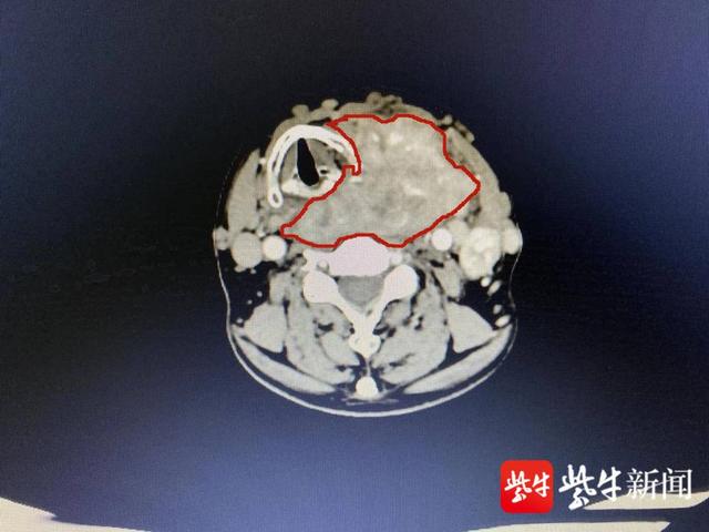 老爷子|七旬老汉肿块缠身20年，专家团队手术切除帮获新生