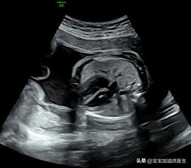 你的育儿经■#洪医生看出生缺陷#——胎儿心脏强光斑是异常吗？