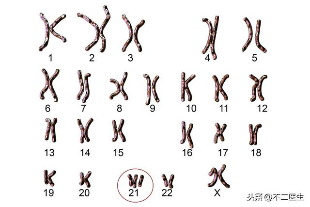 [超级宝妈]今天是3.21号世界唐氏综合征日，唐氏儿，该怎么避免？