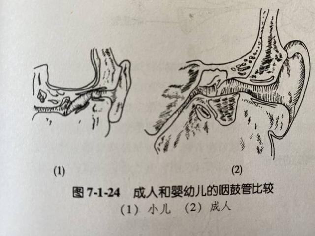 擤鼻涕|7岁女孩患上中耳炎，居然是感冒后擤鼻涕