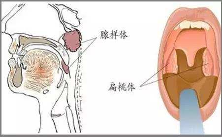 腺样体肥大和扁桃体肥大的区别