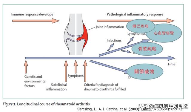 男人易痛风，女人易患类风湿？治疗关节疼痛别“走错门”需对症