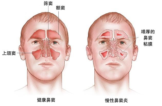 鼻窦炎|耳鼻喉科4月8日起连续3天义诊