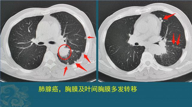 肺癌能治好吗？医生解释3个阶段的治疗数据，避免人财两空