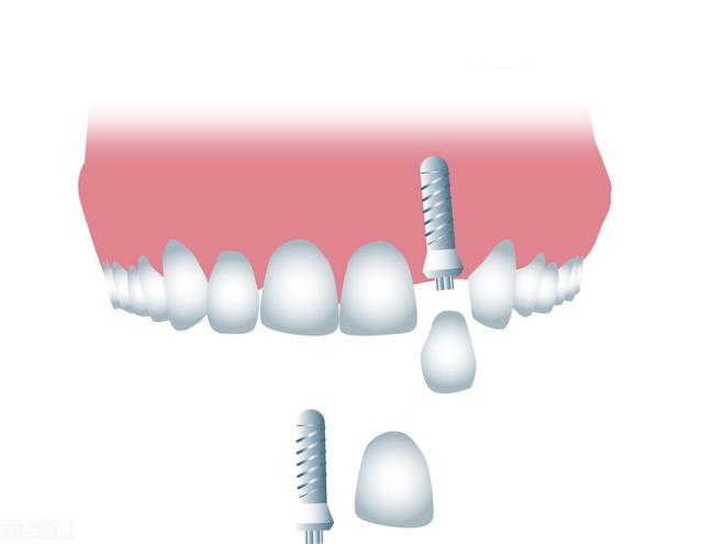 到底什么是种植牙，手术的过程是什么样的？真的值得做吗？