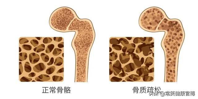 “寂静杀手”骨质疏松症就在身边，您真的了解吗？