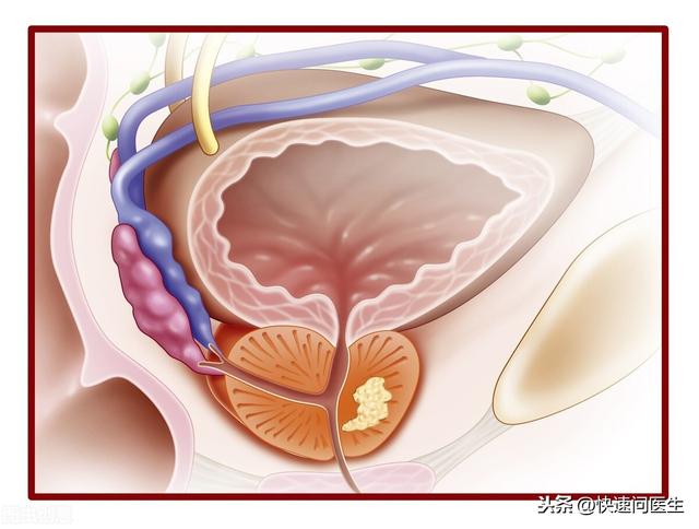 前列腺肥大的原因是什么？这四大因素不容忽视，有可能是致病根源