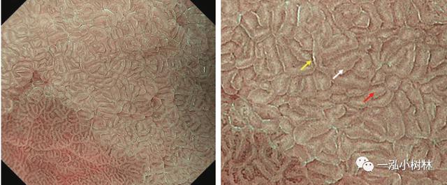 肠上皮化生的放大内镜与病理图像 | 内镜集锦