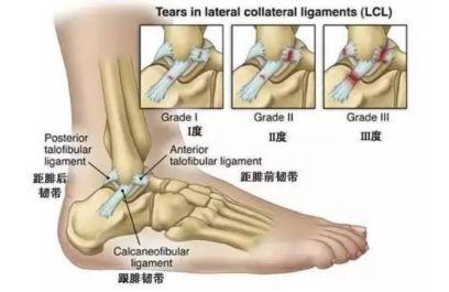 踝关节扭伤后的正确处理与康复