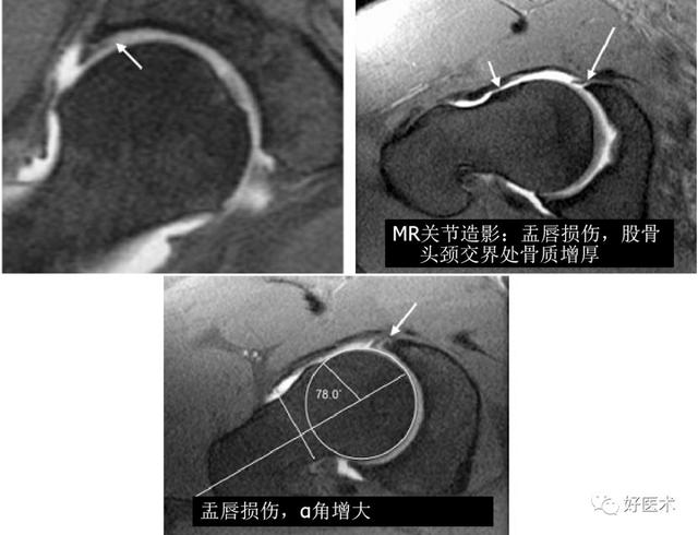 一文读懂髋关节撞击综合征