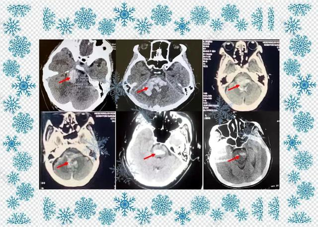 下雪了，气温骤降，脑出血病人明显增加了