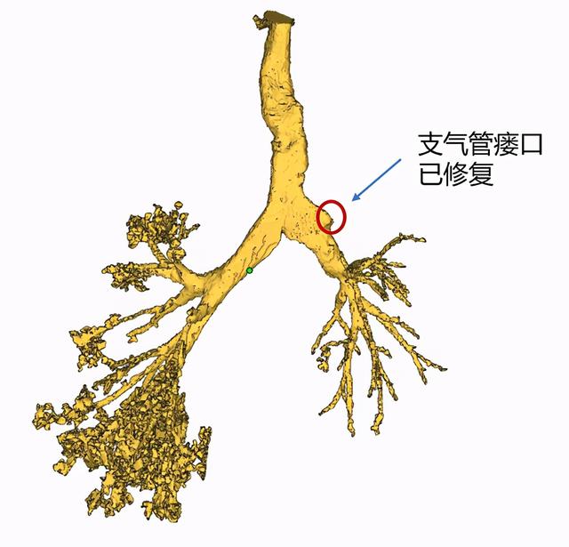 图说:右上肺支气管残端修补良好