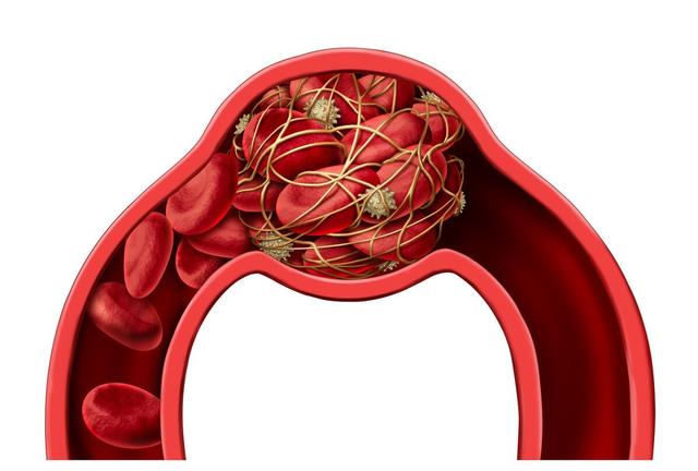 动脉粥样硬化与房颤，形成的血栓颜色不同，预防用药也不同