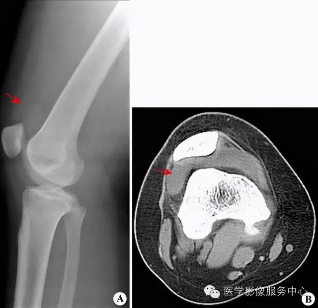 收藏 |：79种典型骨肌影像病例，助你诊断无忧