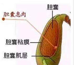 这样的胆囊必须要切掉？济南显微外科苗庆松告诉您