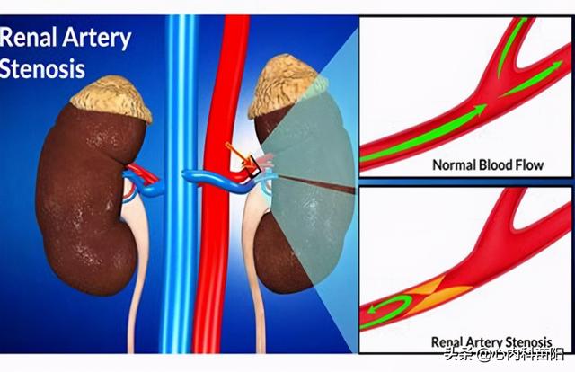 顽固性高血压带来哪些危害？为什么肾动脉狭窄会引起高血压？
