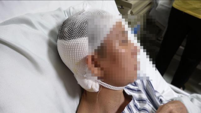 中耳炎|女子洗头时耳朵进水，一年多后险丧命，这种坏习惯很多人都有