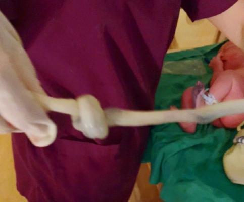 [你的育儿经]谢依霖二胎，发现宝宝脐带打结后怕不已，脐带的这些事孕妈必学